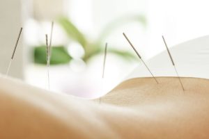 individual experiencing the acupuncture treatment program San Diego provides